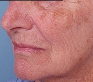 Laser Resurfacing #2-before