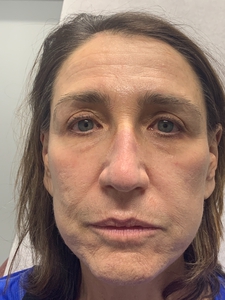 PDL for rosacea-after