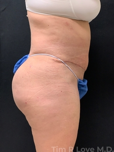 Abdominoplasty - Traditional-after