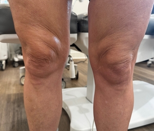 Rejuvenation above the knees-before