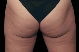 4 Treatments-before