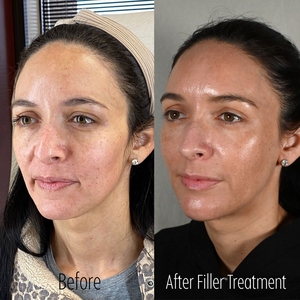 Filler B/A TW Oblique-before