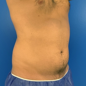 Liposuction #4-before