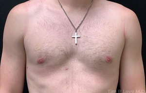 Patient is 2 months Post Bodytite of the chest. Patient is 6'1 and 180 Lbs-after