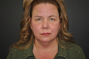 FaceTite & Liposuction 12 Days Front View-before