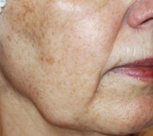 Actinic Elastosis-before