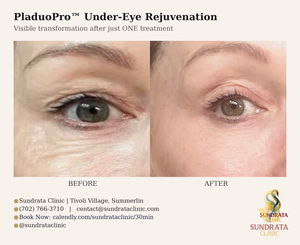 Pladuo Pro - Under Eye Rejuvenation-before