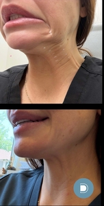 Botox - Nefertiti-before