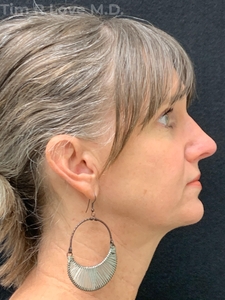 Rhinoplasty - Traditional-after