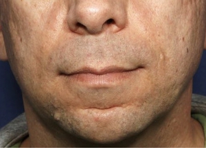 Post Acne Scars-before