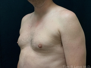 2 months post BodyTite and liposuction of chest to remove gynecomastia-before