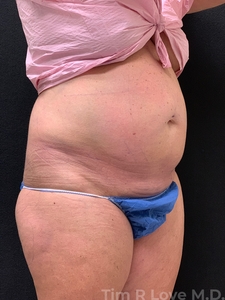 Abdominoplasty - Traditional-before