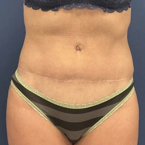 Tummy Tuck #15-after