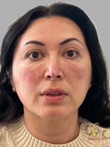 Cellenis Derma PRP 11ML-before