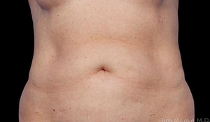 Liposuction - Abdomen-before
