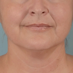 Lipo w Skin Tightening Face #5-before