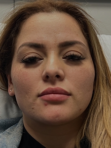 jawline filler-before