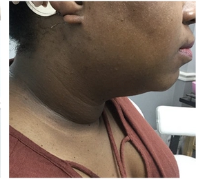 Facial Contouring-after