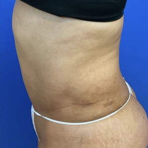 Tummy Tuck #3 (left)-after