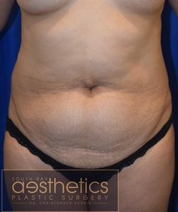 Tummy Tuck + Lipo-before