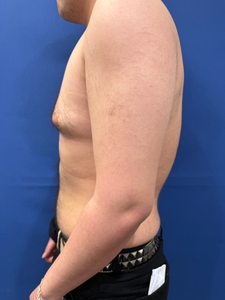 Gynecomastia-before