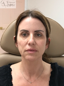 PDO Thread Lift Lower Face-before