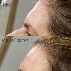 Filler B/A SBA 13-before