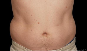 Liposuction - Abdomen-before