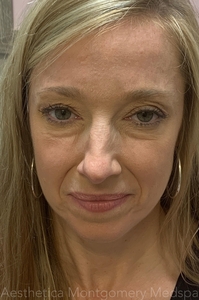 Glabellar complex Jeuveau before and after-after