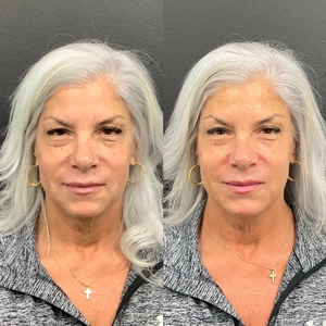 Face balancing-before