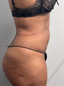 LAL-upper + lower abdomen + mini tummy tuck-after