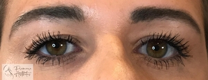 Botox Brow Lift-after