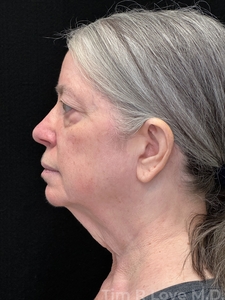 MyEllevate with Upper Bleph-before