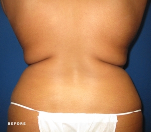 Liposuction #1-before
