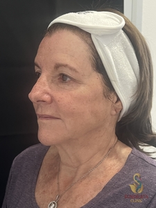 One XERF treatment-after