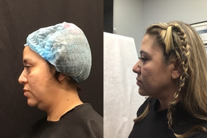 Submental Lipo + Thermitight-before