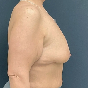 Breast Augmentation #23 435 cc-before