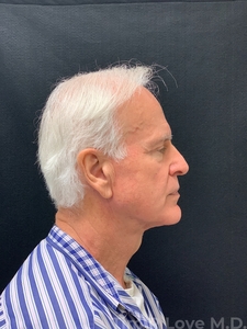 Compare-after