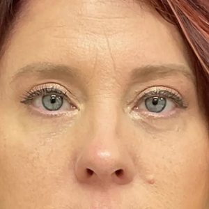 Brow & Eye Lift #4-after