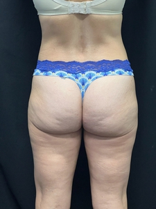 LAL-outer thighs-after