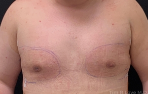 5'7  210# 24 Hour Post Op Bodytite Chest-after