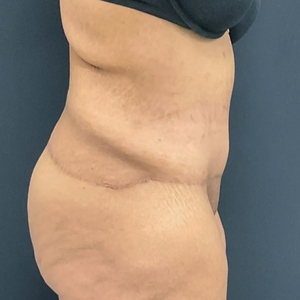 Tummy Tuck #16-after