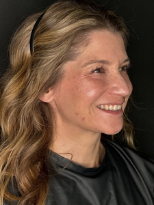 Ashley R. RN. Treated with Botox-before