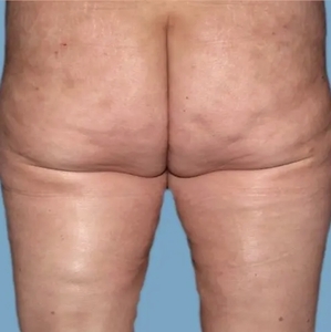 Cellulite Reduction #1-after