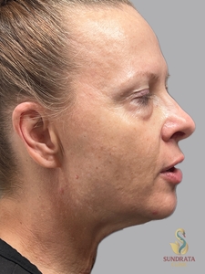 11 ML Cellenis Derma kit used to replace volume in tear troughs, cheeks and Nasolabial folds-before