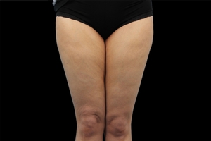 4 Treatments-before