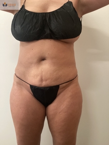 5 Sessions! Insta & Cryo Abdomen-after