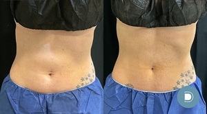 coolsculpting-before