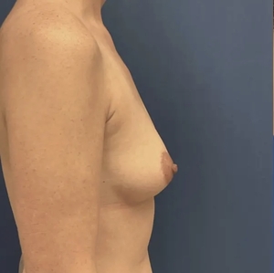 Breast Augmentation #6 355 cc-before