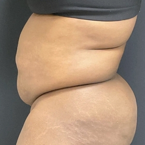 Tummy Tuck #8-before